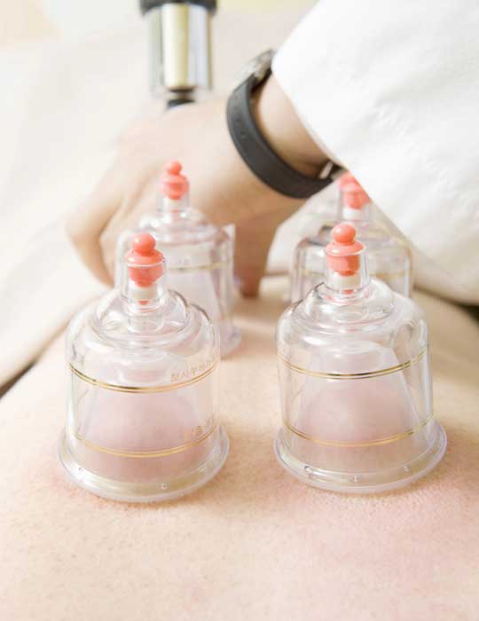 cupping